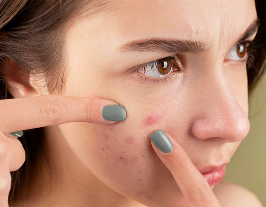 Acne (jeugdpuistjes): Oorzaken en behandeling