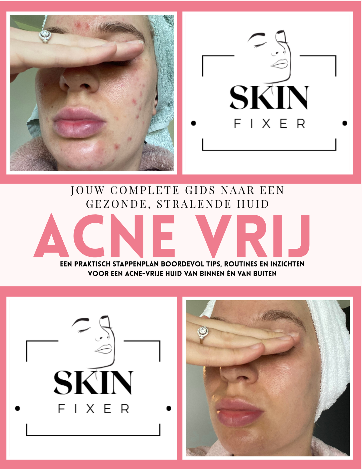 Acne E-book