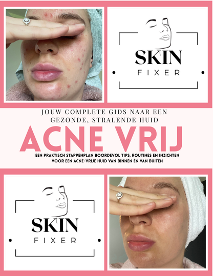 Acne E-book