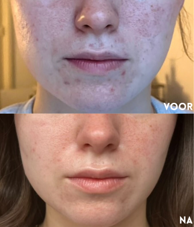resultaat skinfixer nachtcreme vette huid