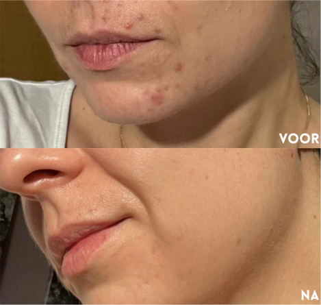 Resultaat skinfixer nachtcreme vette huid hormonale acne