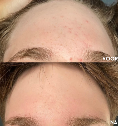 resultaat skinfixer jeugdpuistjes voorhoofd