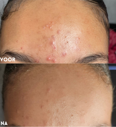 resultaat skinfixer nachtcreme voorhoofd jeugdpuistjes