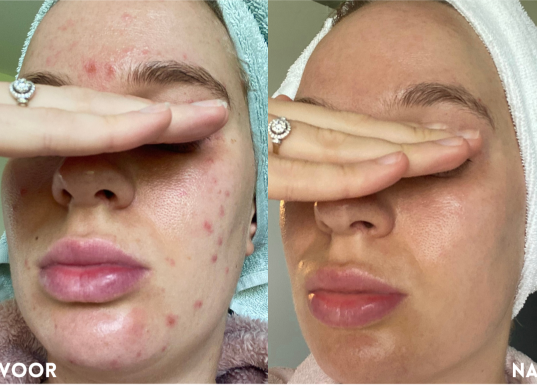 Voor/na acne huid met puistjes